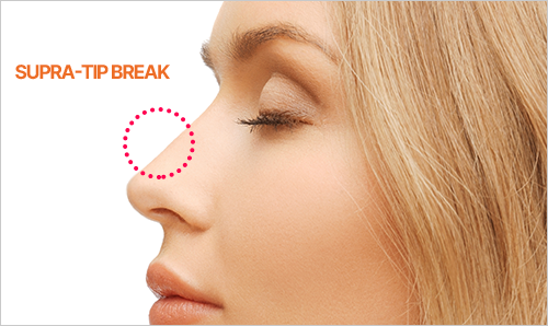 supra-tip break
